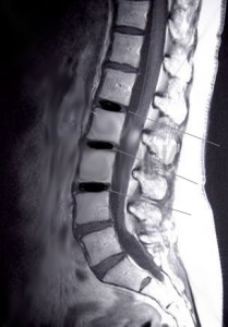 spine injuries can be included under jones act settlements